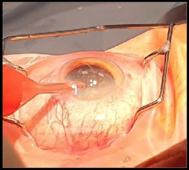 Cataract Surgery