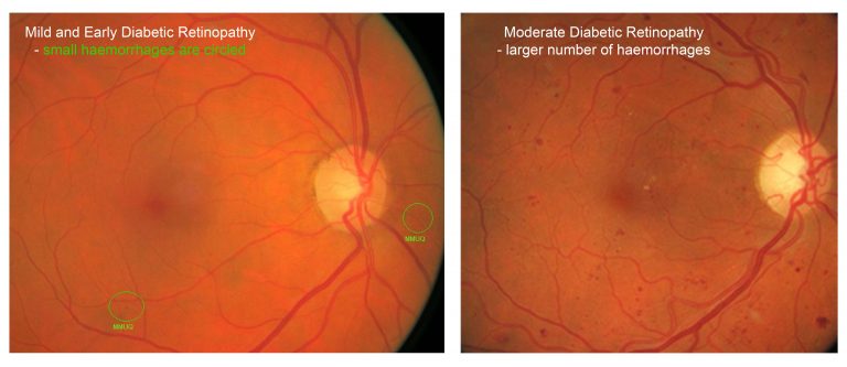 Early Diabetic Retinopathy