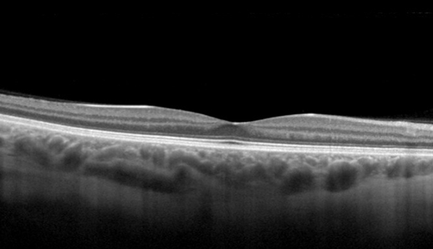 Cross-Section Of A Normal Macula