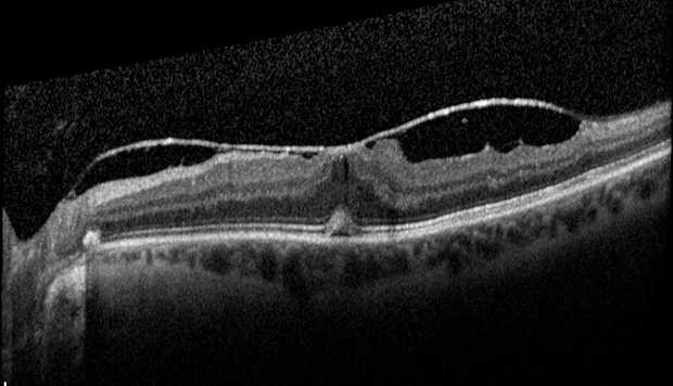 Cross-Section Of Vitreomacular Traction