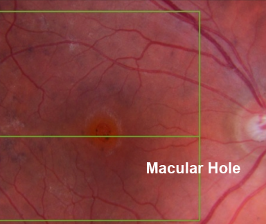 Macula Hole