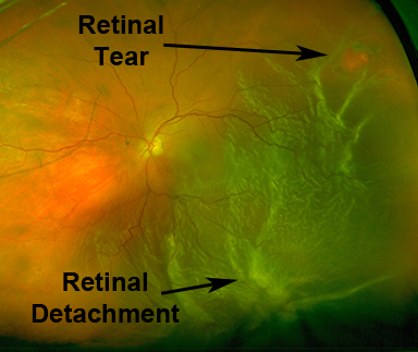 Retinal Tear & Detachment
